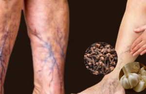 Cloves and Garlic: A Natural Remedy for Leg Pain, Rheumatism, and Arthritis