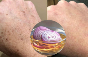 Fade Dark Spots Naturally with Onion and Apple Cider Vinegar