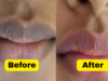 Say Goodbye to Dark Lips: Home Remedies for Lip De-Pigmentation
