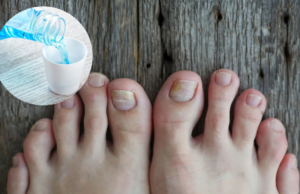 No More Nail Fungus! Try This Powerful Home Treatment