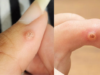 Say Goodbye to Warts, Pimples, and Skin Tags with These Natural Treatments