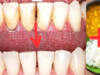The Dentist’s Secret: Remove Tartar and Whiten Teeth in Just 2 Minutes