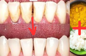 The Dentist’s Secret: Remove Tartar and Whiten Teeth in Just 2 Minutes